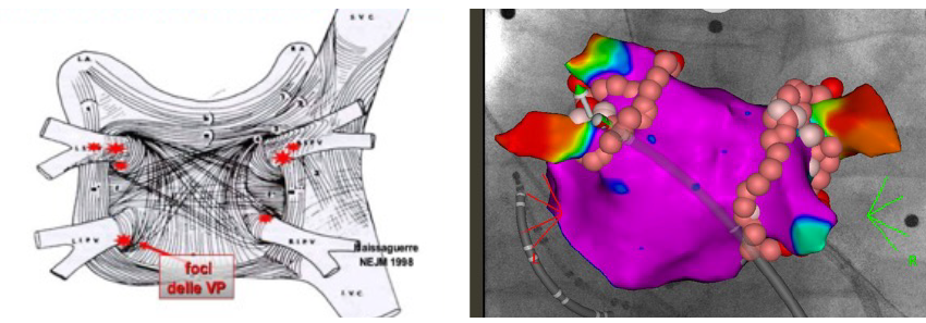 Fig. 1A) Rappresentazione dell’atrio sinistro: nelle zone circostanti gli osti delle vene polmonari sono presenti i foci aritmogeni che danno inizio alla fibrillazione parossisitica.B) Viene eseguita la disconnessione delle vene polmonari mediante lesioni ablative che isolano elettricamente foci che non trasmettono più  la aritmia all’atrio.