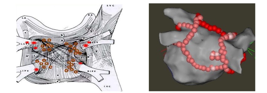  A) Rappresentazione dell’atrio sinistro: area estesa della parete posteriore con con cortocicuiti che sostengono la fibrillazione atriale.B) Viengono eseguite lesioni lineari che isolano elettricamente anche l’area di parete atriale alterata.