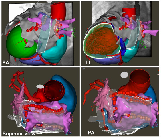 ablazione endo-epicardica della fibrillazione atriale, alle applicazioni ablative sulla superficie interna del cuore (pannelli superiori) si aggiungono erogazioni sulla superficie esterna (pannelli inferiori) per poter eliminare i tessuti malati a tutto spessore.